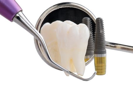 dental implant and dental tools